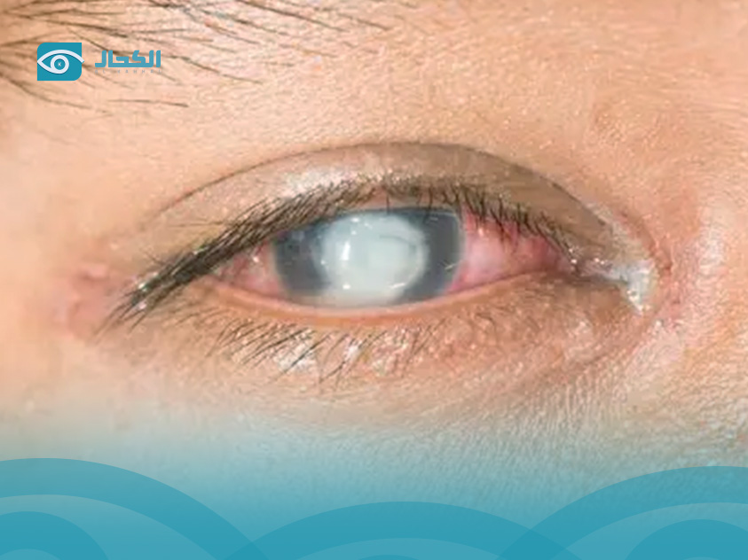 قرحة القرنية