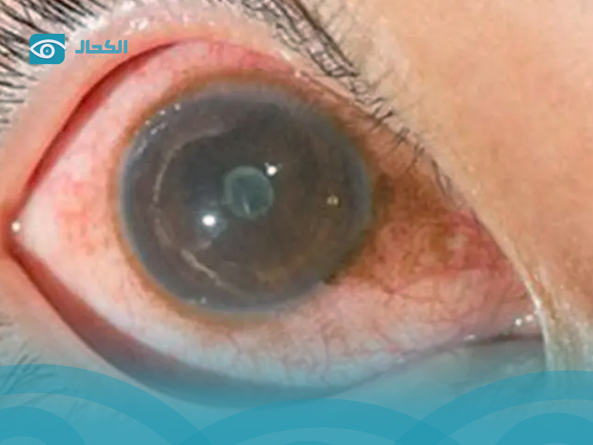 قرحة القرنية