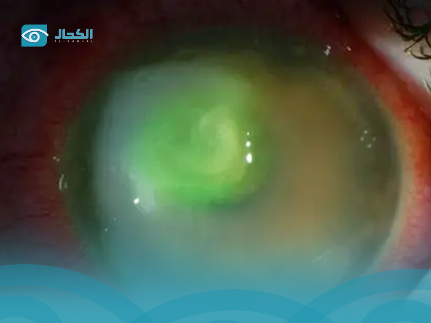 قرحة القرنية