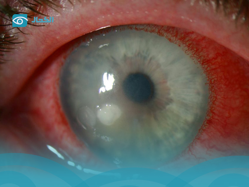 قرحة القرنية