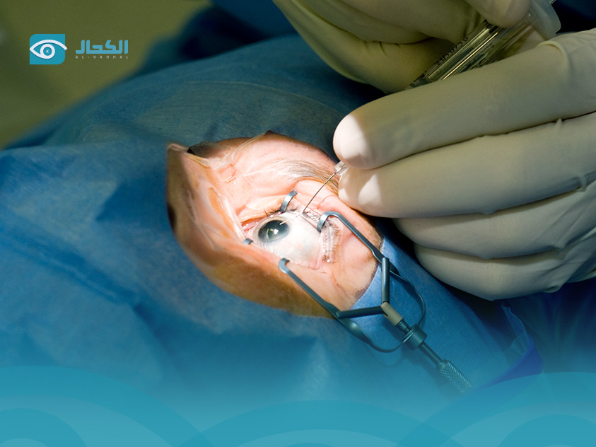 تعليمات ما بعد الليزك