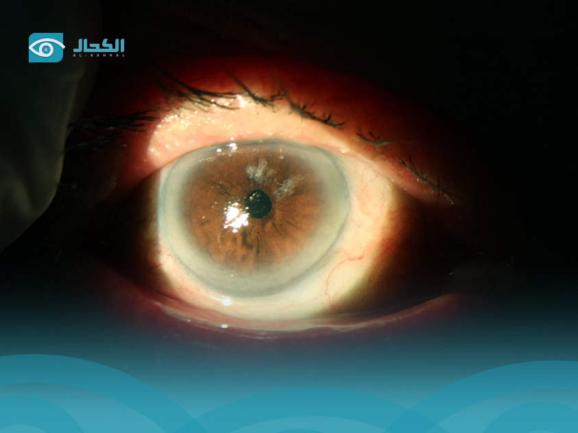 اسباب الضمور البصري