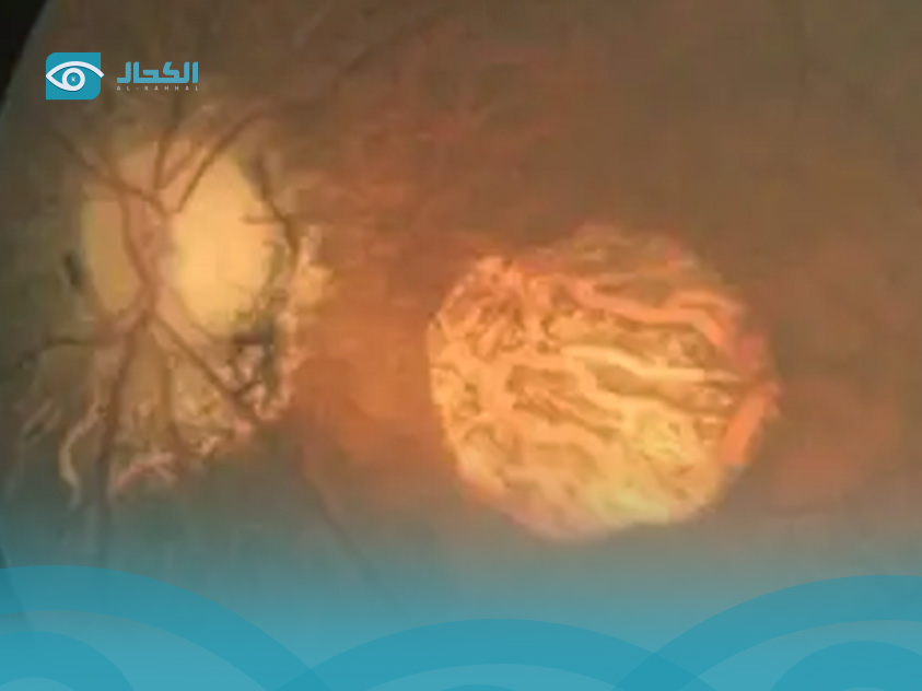 علاج الضمور البصري