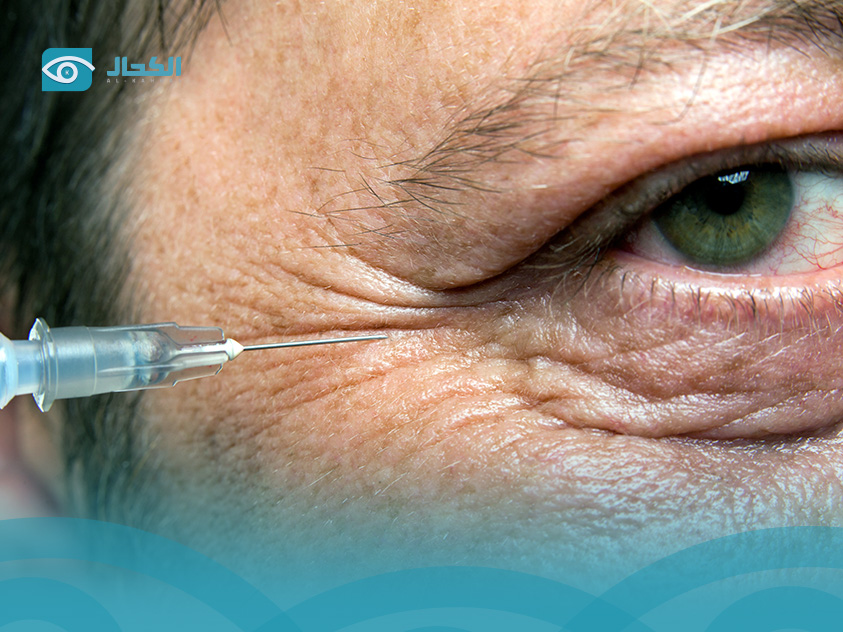 حقن العين