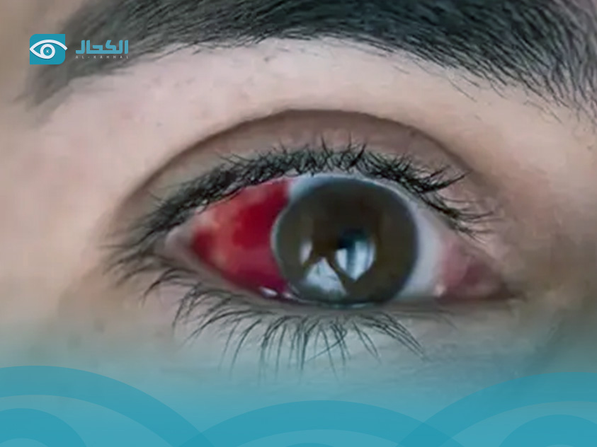أسباب نزيف العين