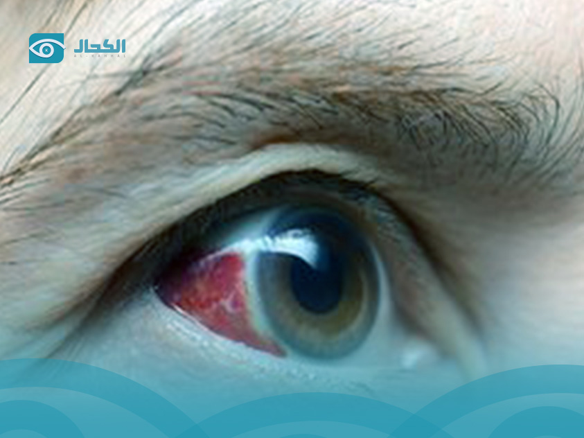 أسباب نزيف العين