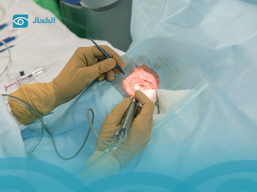 عملية سحب الماء من العين