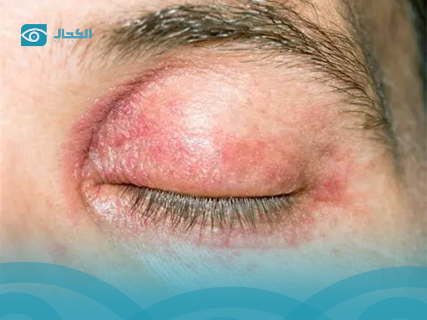  علاجات منزلية لألم العين