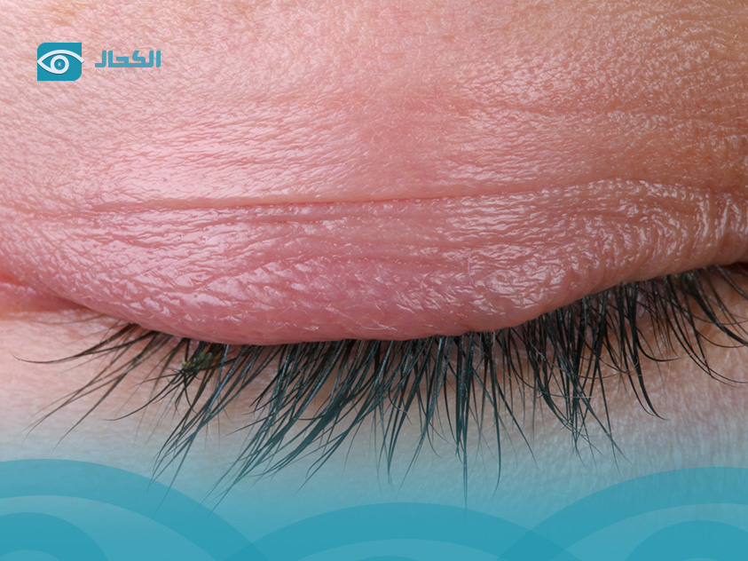  علاجات منزلية لألم العين