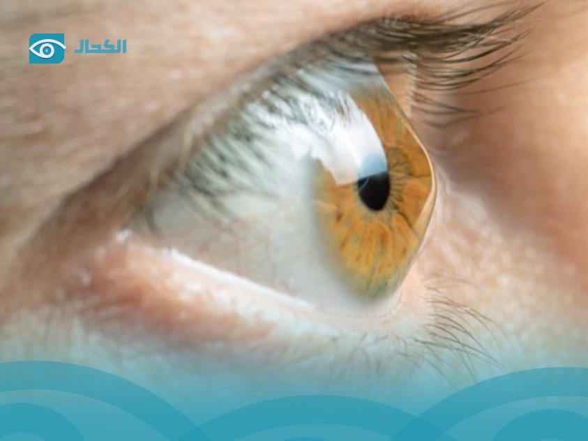 القرنيه المخروطيه