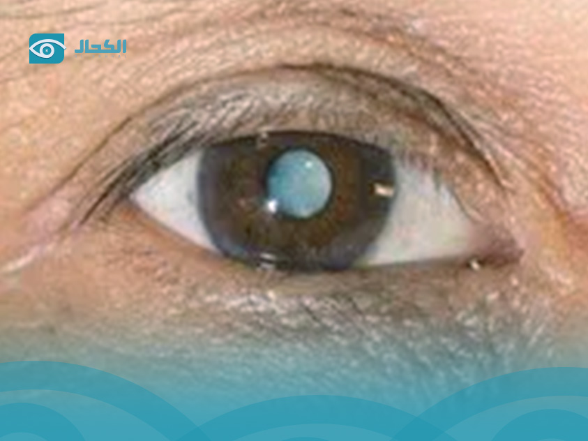  مريض الجلوكوما