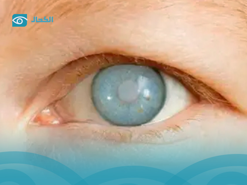  مريض الجلوكوما