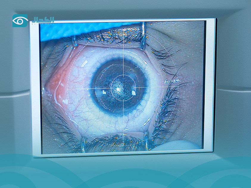 أسعار الفيمتو ليزك في الدمام