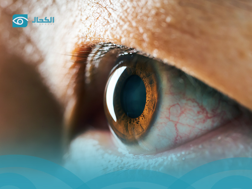 علاج-ضعف-النظر-المفاجئ