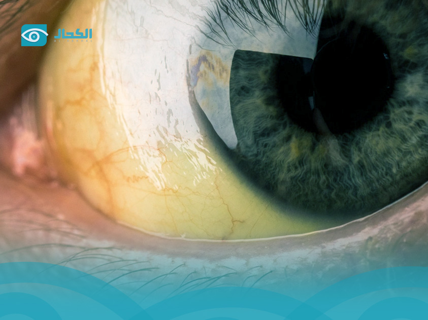 علاج-صفار-العين-للكبار