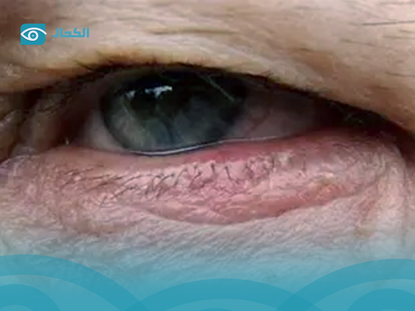 التهاب-جفن-العين-السفلي