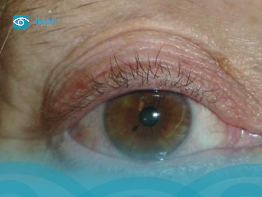 اسباب-التهاب-جفن-العين-السفلي