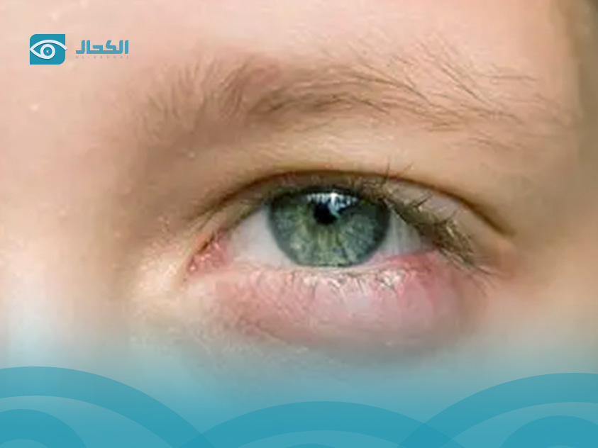 علاج-التهاب-جفن-العين-السفلي-من-الخارج