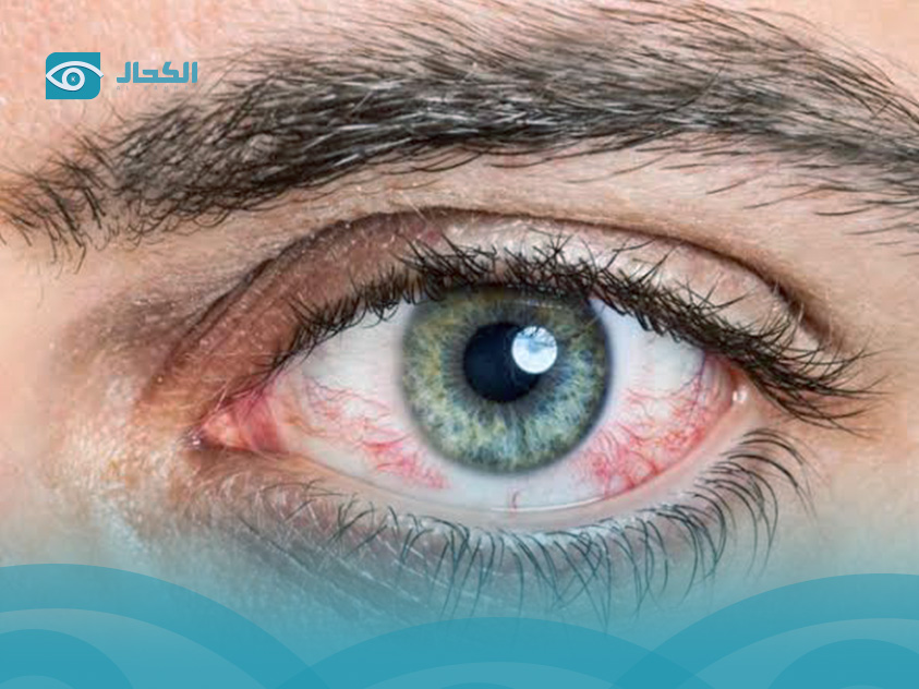 تحسس-العين-من-الضوء تحسس-العين-من-الضوء