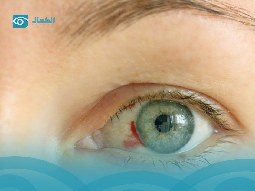 نزيف-شبكية-العين-لمرضى-السكري