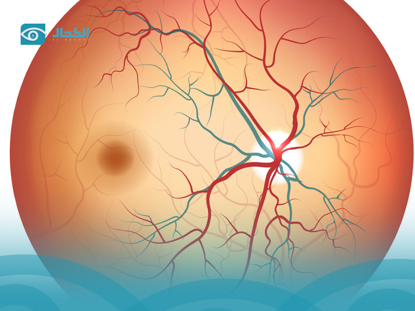 نزيف-شبكية-العين-لمرضى-السكري