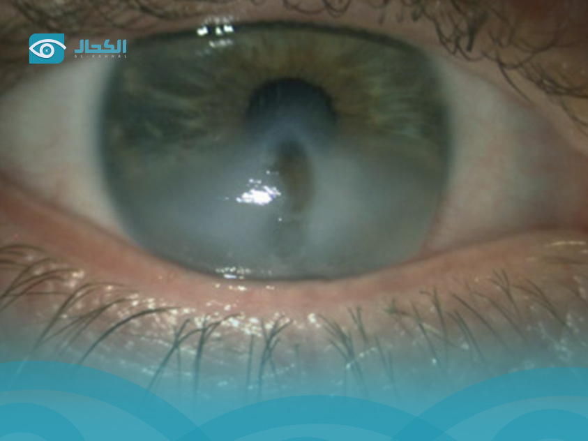 ظهور-لون-رمادي-حول-عدسة-العين