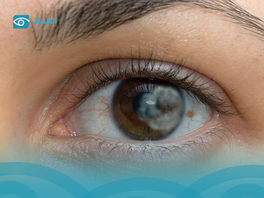 وجود-لون-رمادي-في-بياض-العين-عند-الاطفال