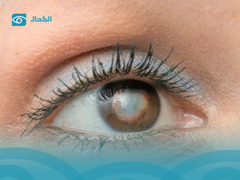 وجود-لون-رمادي-في-بياض-العين-عند-الاطفال