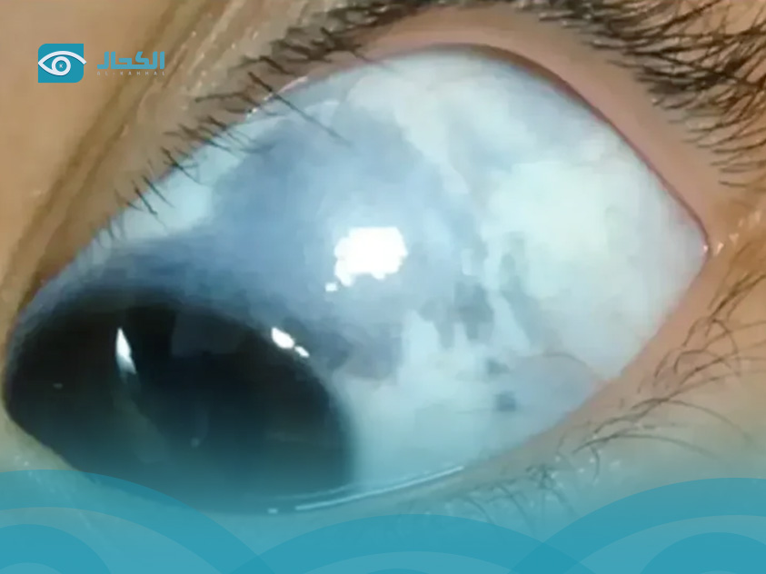 ظهور-لون-رمادي-حول-عدسة-العين