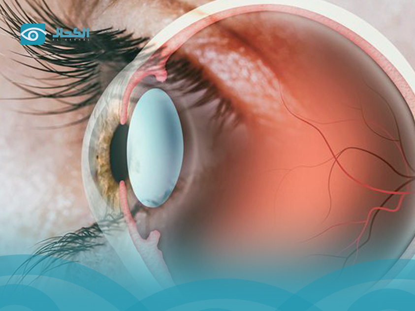 انفصال-السائل-الزجاجي