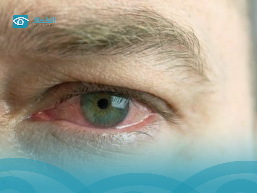 علاج-انفصال-السائل-الزجاجي-في-العين