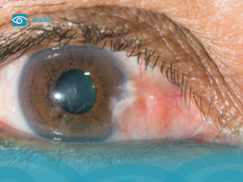 أعراض-ظفر-العين