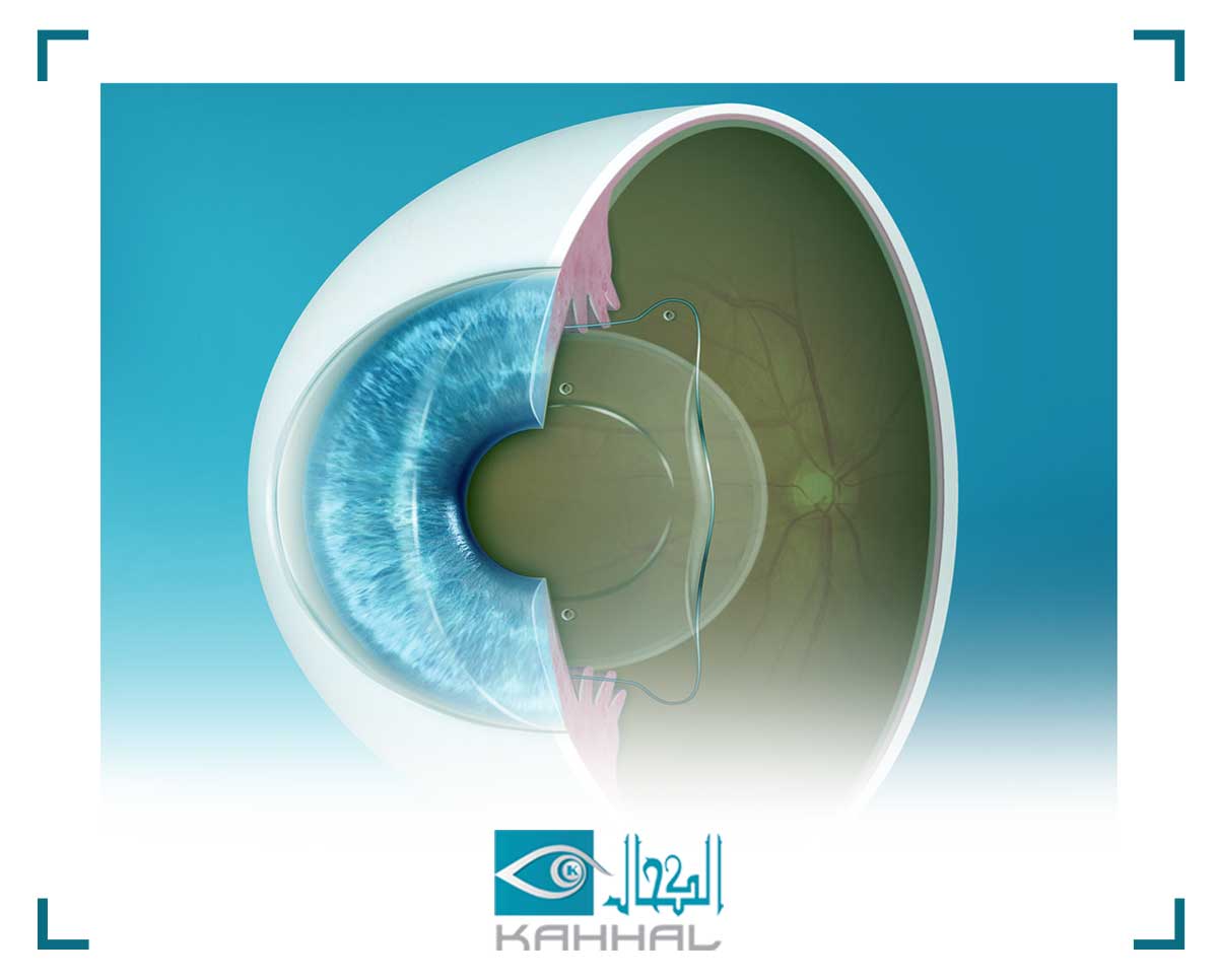 زراعة العدسات داخل العين