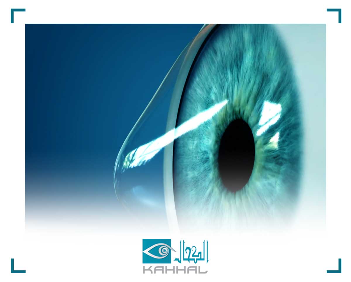 علاج القرنية المخروطية بالليزر