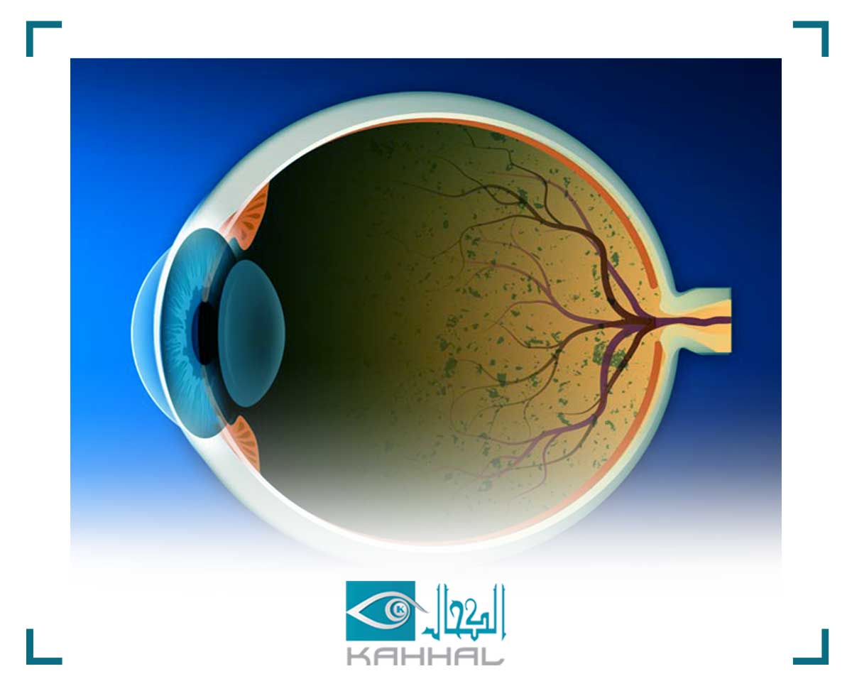 افضل دكتور لعلاج انفصال الشبكيه
