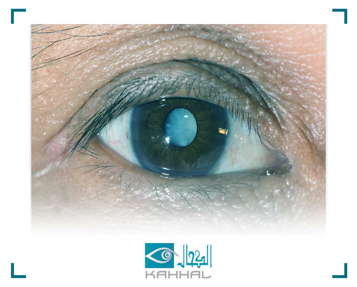 تكلفة جراحة الساد بالليزر في مصر