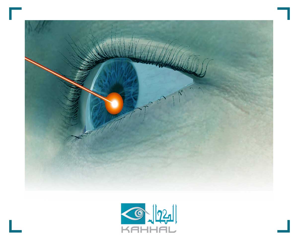 جراحة العين بالليزر