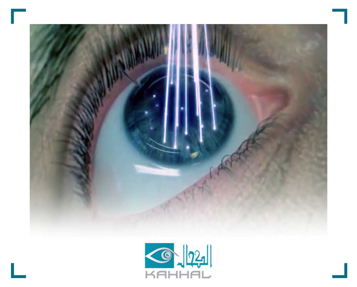 تصحيح الإبصار بالليزر والليزك