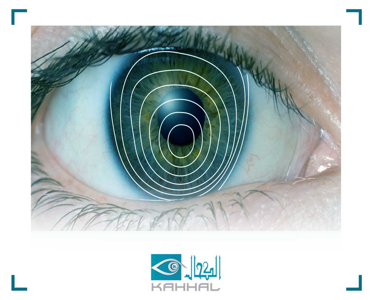 معلومات عن القرنية المخروطية