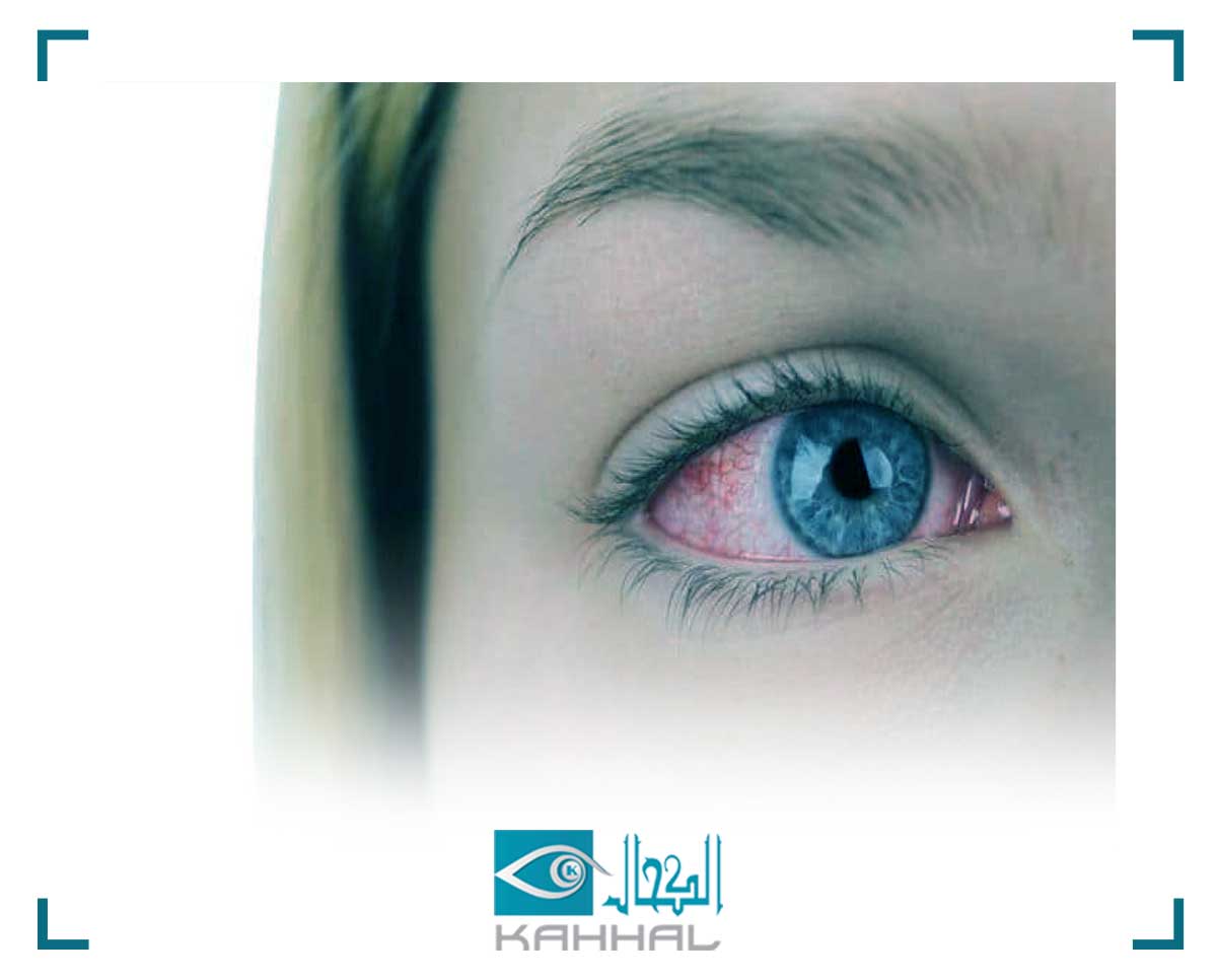 اسباب نزيف العين