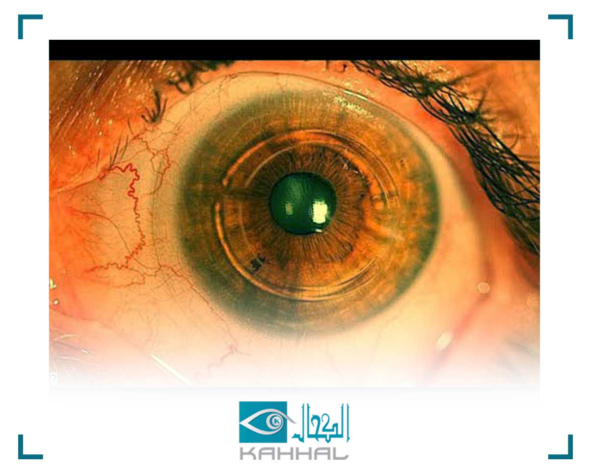 ما لا تعرفه عن القرنية المخروطية