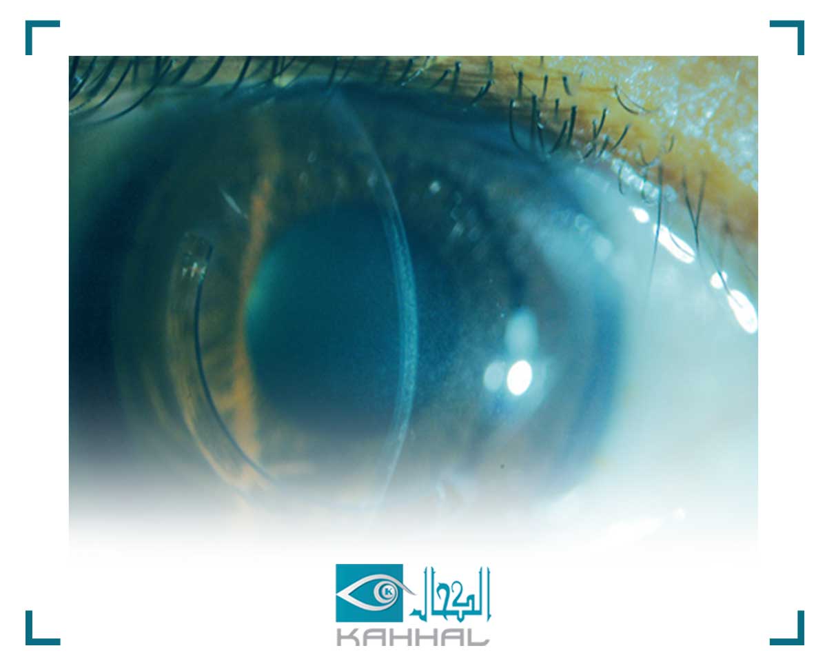 اسباب القرنية المخروطية