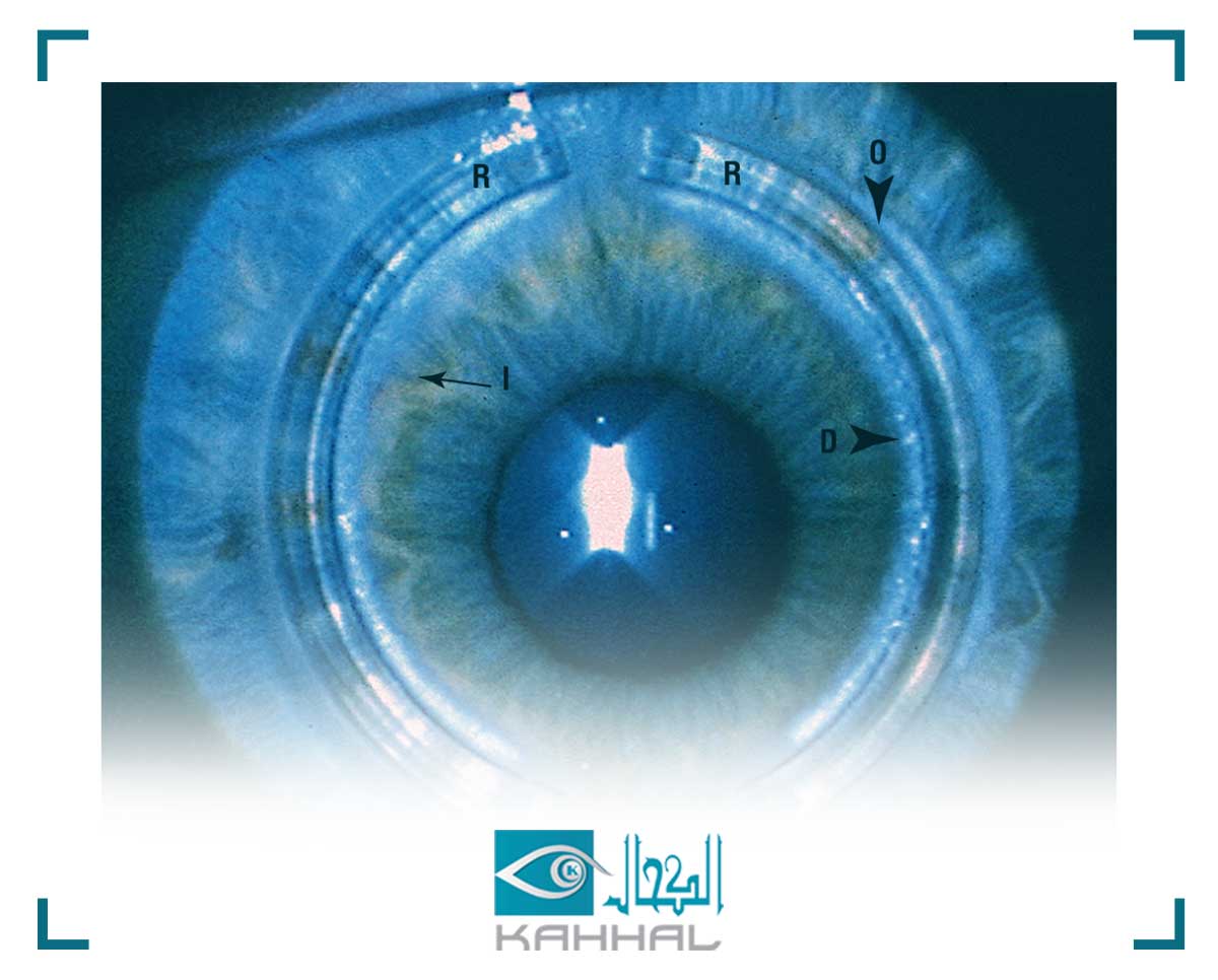 معلومات مهمة عن القرنية المخروطية