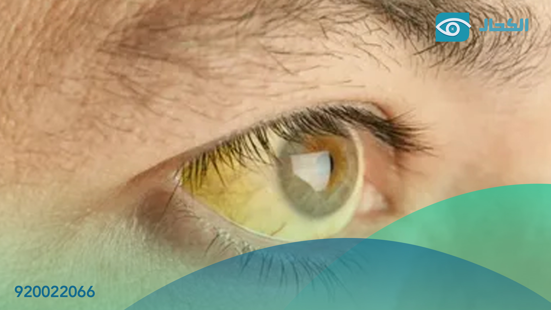 علاج اصفرار العين