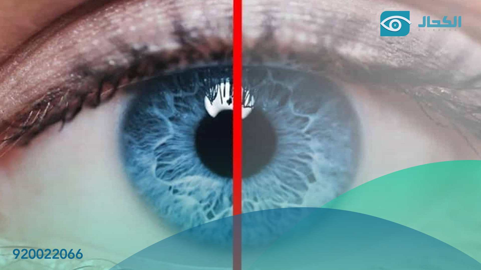 ازالة الماء الابيض والمياه الزرقاء