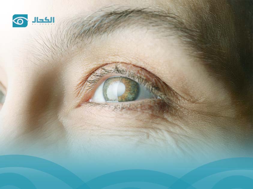 الفرق بين الماء الأبيض والماء الأزرق على العين