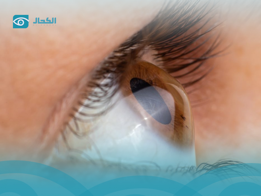 Keratoconus Treatment&nbsp;