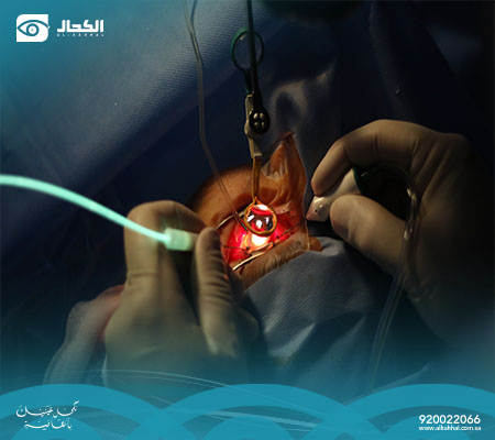 عملية الجسم الزجاجي في العين