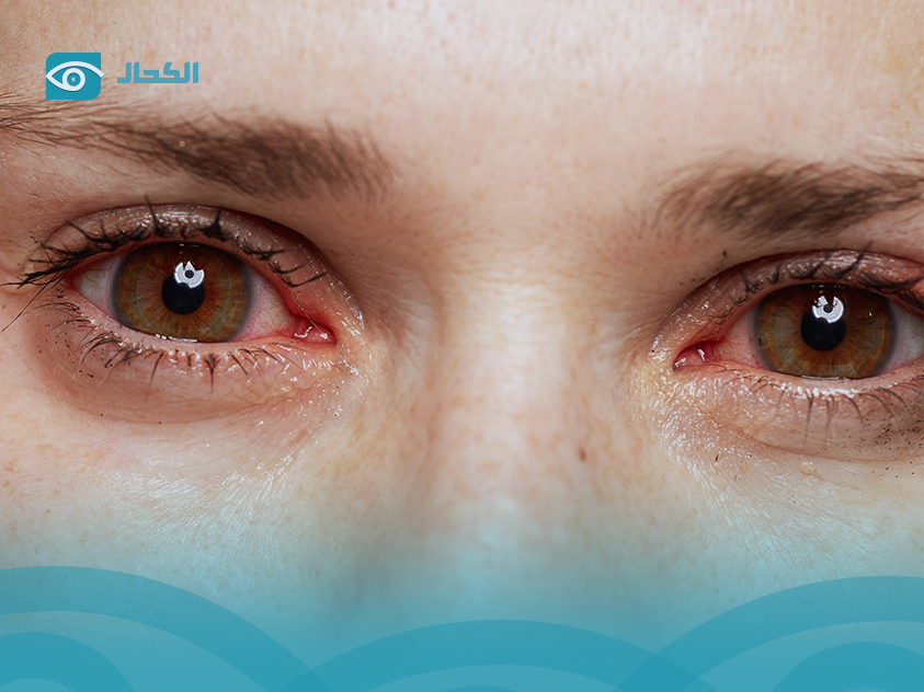اسباب جفاف العين