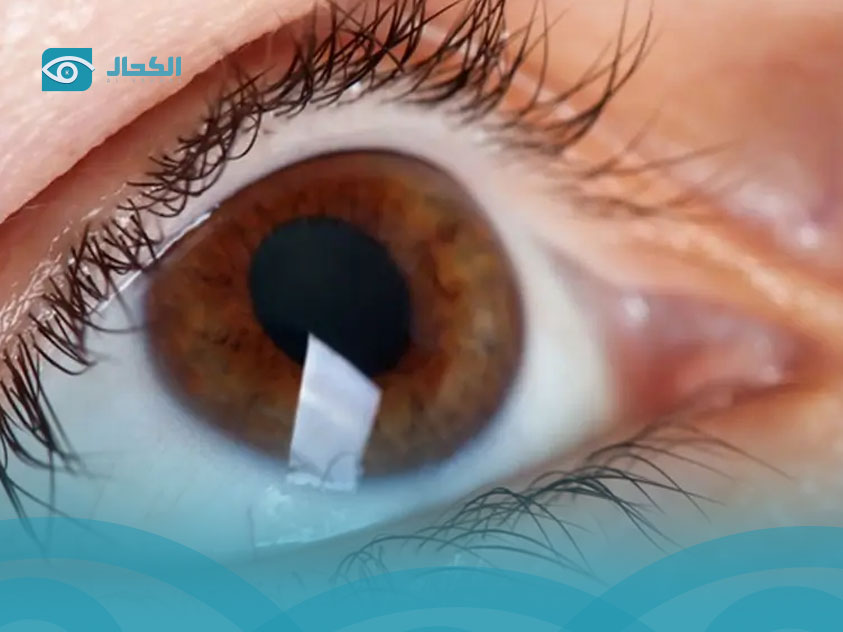 خدش-القرنية